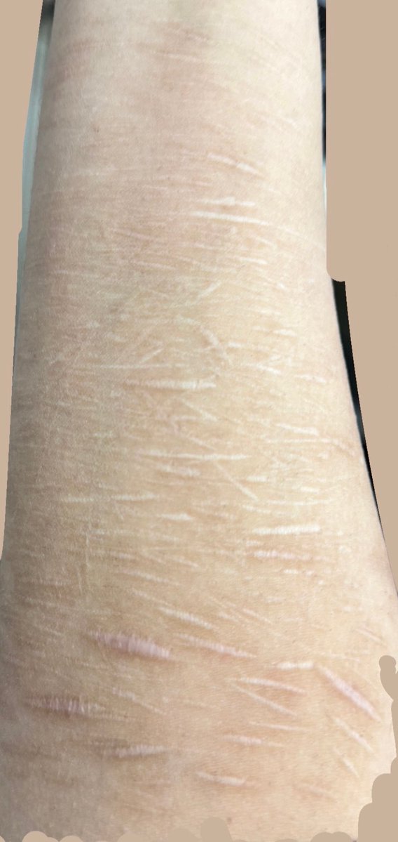 xana4200's tweet photo. My scars healed so weird omg 😭 idk how most of the fat ones disappeared in just six months https://t.co/89Edllm0hh