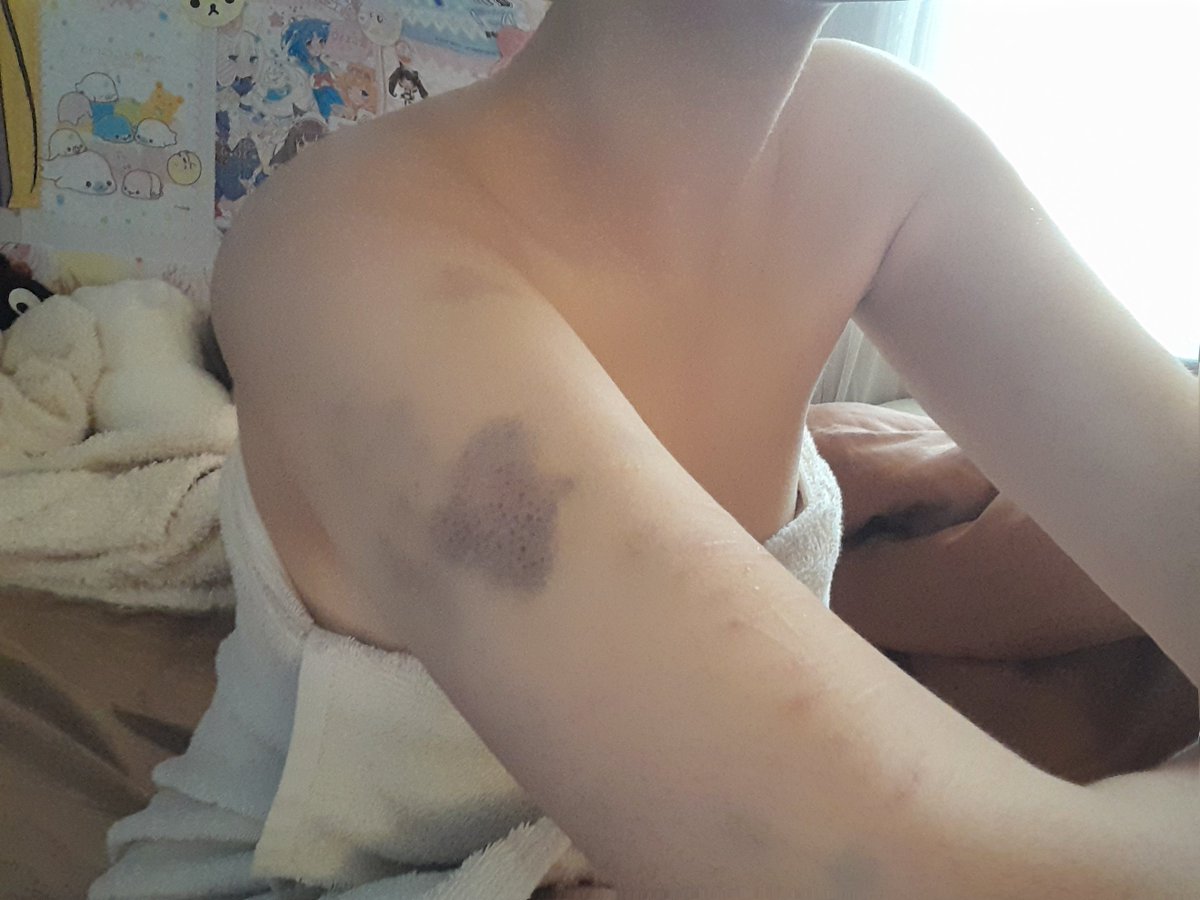 AshisPogg's tweet photo. purpleHWJAKEKX #edtwt #shtwt #shedtwt #drugtwt #bruisetwt #hi #cutecore https://t.co/BBzVlPNSOx