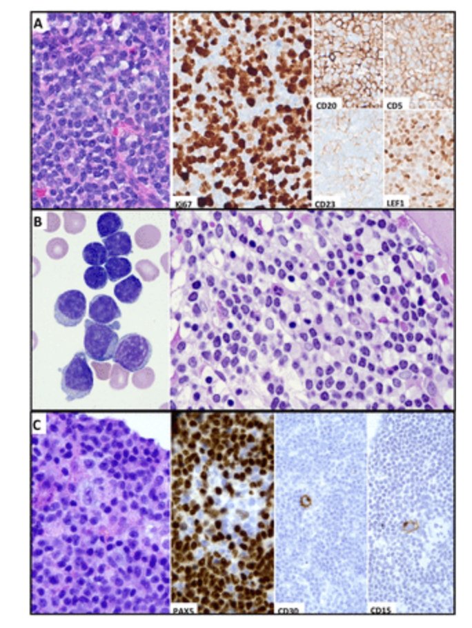 pembeoltulu's tweet photo. Fifth edition WHO classification: mature B-cell neoplasms;

You can read it, It is totally free;

https://t.co/5ra2BtqkeE

@JClinPath_BMJ  @Vik_deshpandeMD @archibhat3 @DrGeeONE https://t.co/TEPgvOUjmW