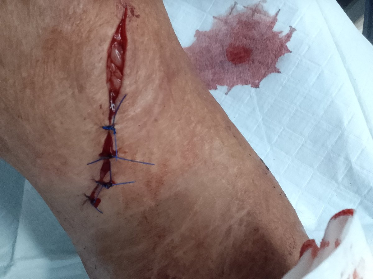 Analee1mil's tweet photo. @b3rnttoast It hurt like a bitch 
That's what it looks like  when they stitch it up https://t.co/G0SJB7BW7k