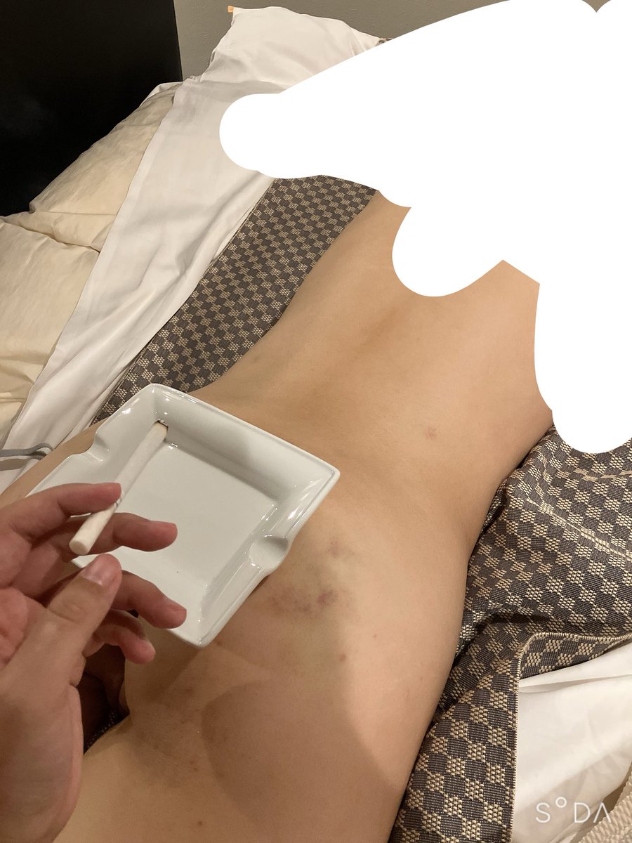 Airu9yfd's tweet photo. ペットのケツに灰皿置いた時のやつ。
灰飛ばしたら飛び跳ねたけど
めちゃ喜んでて濡れてたの笑った笑
おしりの跡も痛そうだね💕︎ https://t.co/HgbkQzDv1y