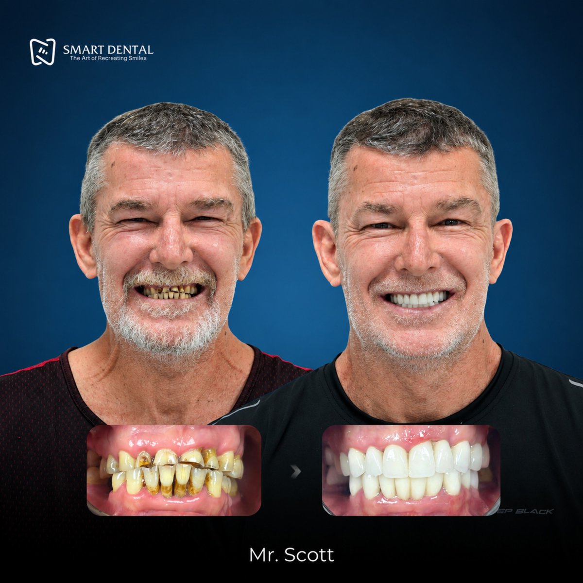 gustavomolotla's tweet photo. Every smile has a unique story. Personalised treatment can enhance tooth colour, shape, alignment and balance while keeping results natural. Considering dental treatment in Vietnam? Contact Smart Dental Vietnam for a free consultation and treatment https://t.co/uZUaOFHfMR