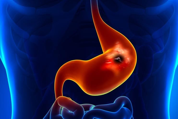BioBite_'s tweet photo. ULCER

Stomach pain that eases with an antacid, then keeps coming back?

1. The signs https://t.co/zxIRRaR3Ko