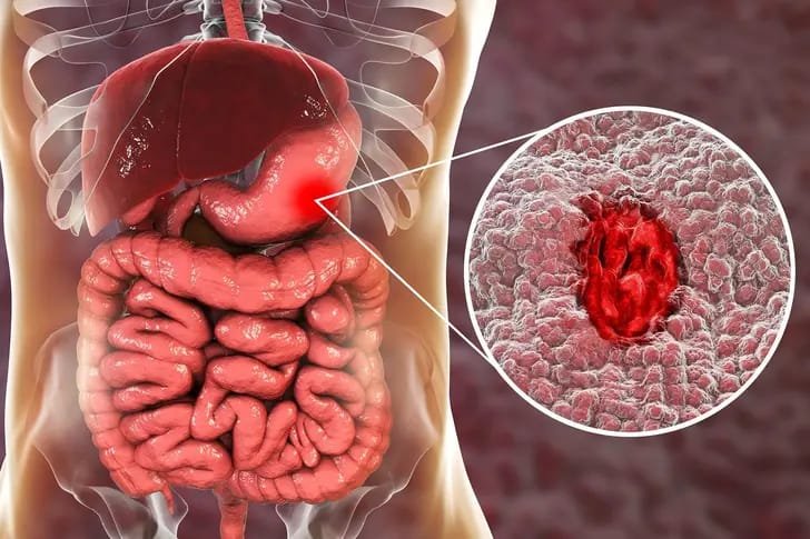 BioBite_'s tweet photo. ULCER

Stomach pain that eases with an antacid, then keeps coming back?

1. The signs https://t.co/zxIRRaR3Ko