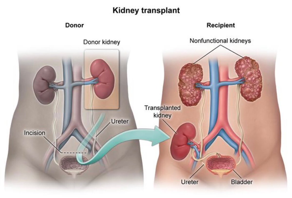 ClinicalDepth's tweet photo. DID YOU KNOW THAT WHEN YOU RECEIVE A DONATED KIDNEY, THEY DON’T REMOVE THE BAD ONE, THEY JUST ADD THE NEW ONE?

When someone’s kidneys fail and they need a kidney transplant, you might assume the surgeons will remove the two damaged kidneys and replace them with a healthy one.

BUT THAT IS NOT WHAT USUALLY HAPPENS! 🔥

In most kidney transplants, the patient's original kidneys are left inside their body. Instead, the surgeon places the donated kidney in the lower abdomen, connects it to the blood vessels and bladder, and allows it to take over much of the work of filtering the blood and producing urine.

Read that again! 

*TWO OLD KIDNEYS + ONE DONATED KIDNEY = THREE KIDNEYS IN ONE BODY!*

And no, the original kidneys do not necessarily have to be removed just because they have stopped working properly. Doctors usually leave them alone unless there is a medical reason to take them out.

Of course, there are exceptions. If the original kidneys cause certain complications, such as recurrent infections, cancer or other serious problems, doctors may decide to remove one or both.

But here's what you need to know: the donated kidney doesn't even need to occupy the original kidney's position to function! It can do its job from its new location in the lower abdomen.

Human anatomy will humble you if you let it. 🌚
Imagine carrying three kidneys and still not knowing where your spare one is!