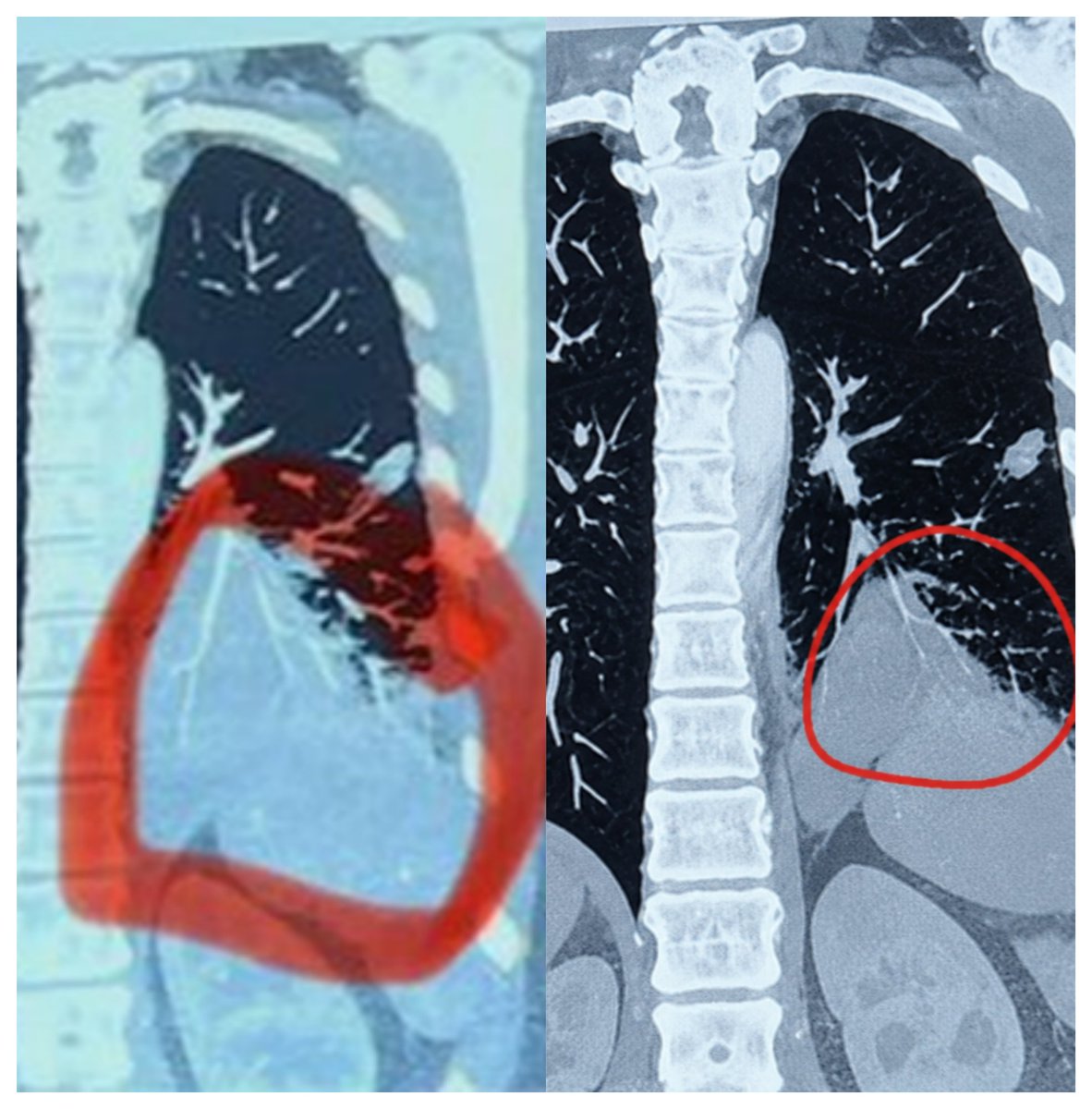 EmmaBrooks09's tweet photo. 🚨 Stage IV Lung Cancer Update — Tumor Reduction Reported!

This is the protocol behind the approach I’ve been working with:

• Ivermectin — 72 mg
• Mebendazole — 500 mg
• DMSO — ½ tsp
• C60 — 1 tsp
• Turmeric — 1,500 mg
• Resveratrol — 500 mg https://t.co/X4MWOm27Gh