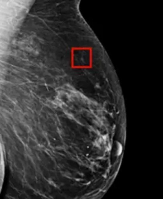 RincnCuriosoo's tweet photo. La Inteligencia Artificial identificó cáncer de mama en una mujer 5 años antes de que la enfermedad se desarrollara. https://t.co/Raqrru34t4