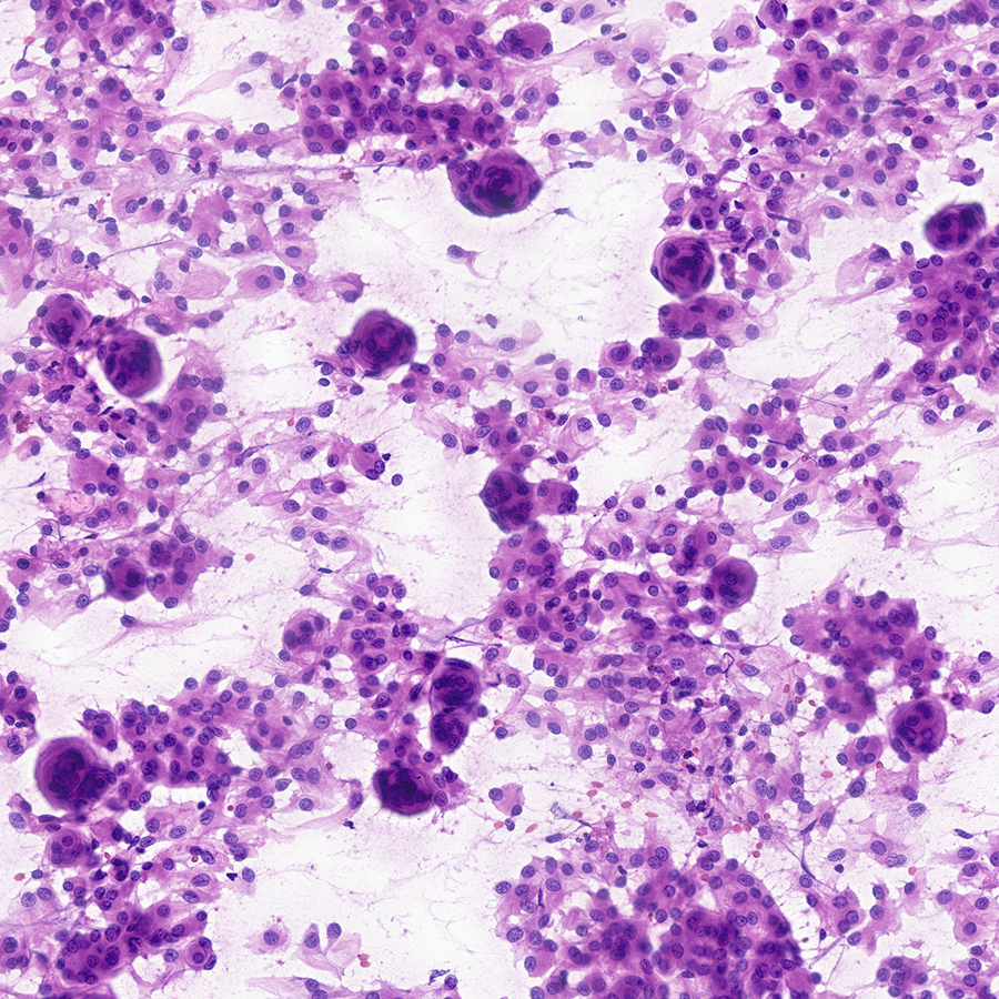 CraigHorbinski's tweet photo. One look at this intraoperative smear prep and you can diagnose this brain tumor. #pathology #neuropath #pathtwitter https://t.co/zrWAIqT7g8