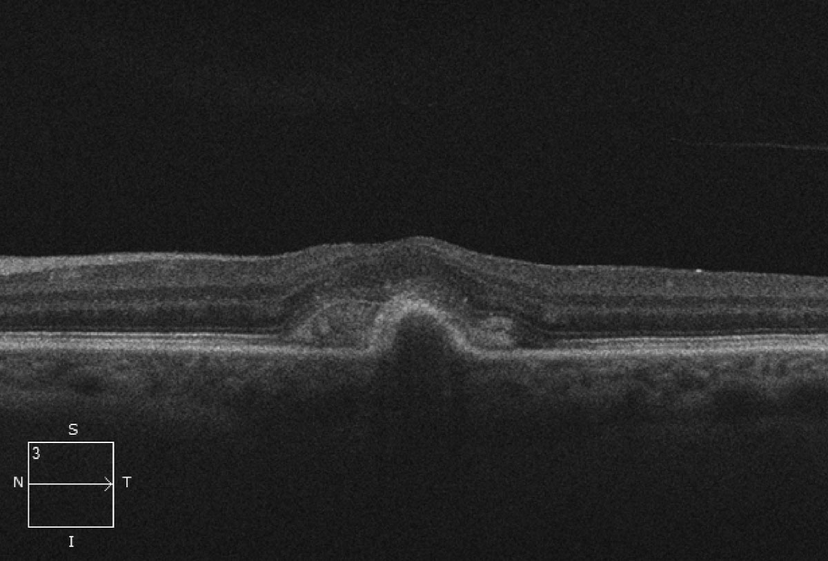 revoptom's tweet photo. RPE Tears in AMD Associated with PED Height and Surface Area

Incorporating quantitative measurements and instability biomarkers into routine OCT assessment may guide risk stratification and inform follow-up intensity.
Read the story: https://t.co/yb1MtrynM8

#retina #optometry #AMD