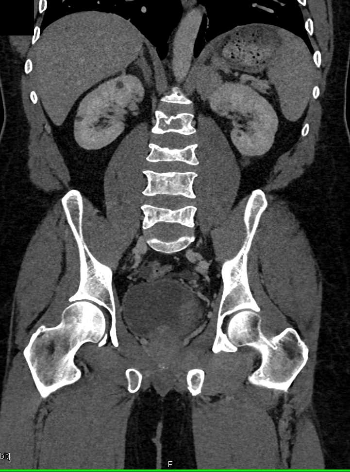 ctisus's tweet photo. Subtle Gastric Adenocarcinoma: https://t.co/T9J2beexXn https://t.co/wmXb65FnY5