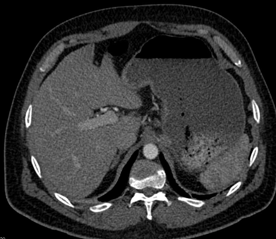 ctisus's tweet photo. Subtle Gastric Adenocarcinoma: https://t.co/T9J2beexXn https://t.co/wmXb65FnY5