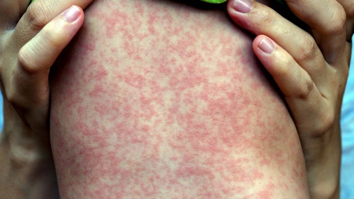 1_mincrafts's tweet photo. 22 COMMON SKIN RASHES: CAUSES AND TREATMENT

Not every red, itchy patch is the same, and the wrong cream can make it worse.

1. Shingles (herpes zoster) https://t.co/npRgjtYezJ