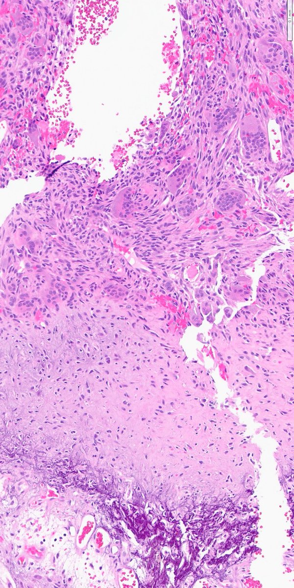 ZemplenPataki's tweet photo. Bone. What is your diagnosis?🔎

Poll below 🗳️👇

#PathPuzzle 🕵️‍♂️
@UMichPath #Pathology #PathX #PathTwitter https://t.co/6TxGNYZNe1