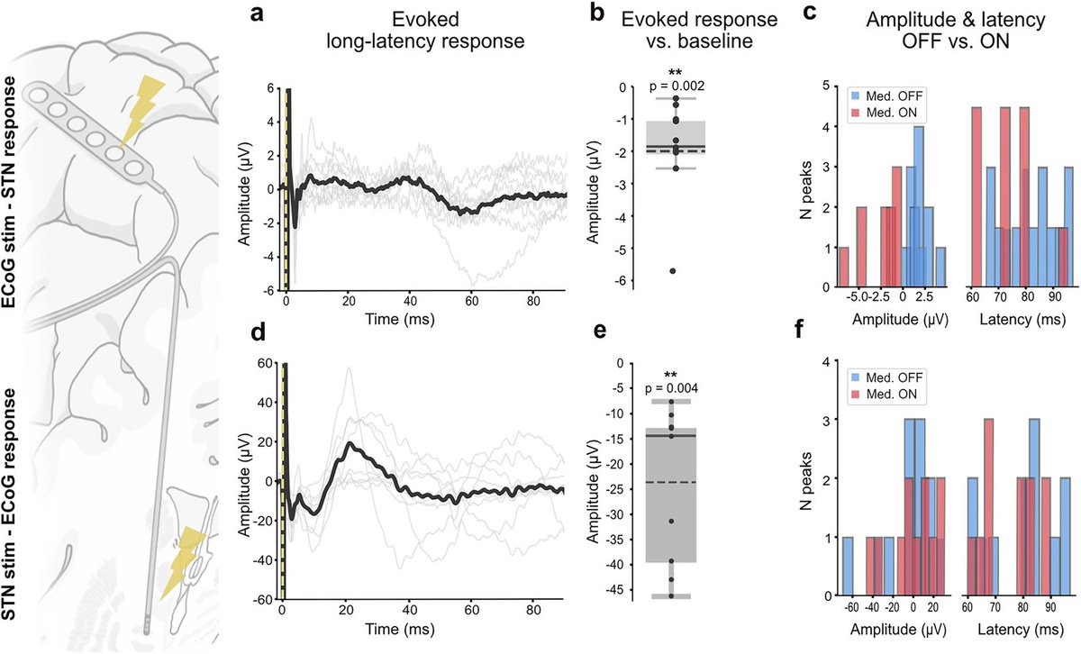 ScienceofPD's tweet photo. New research from @neumann_wj et al finds a temporal dissociation within the cortex–basal ganglia network, whereby fast cortical transmission is unaffected by dopamine, which in turn amplifies slower network level communication to the subthalamic nucleus
https://t.co/iql5RMNmRB https://t.co/x9HQsCkxYR