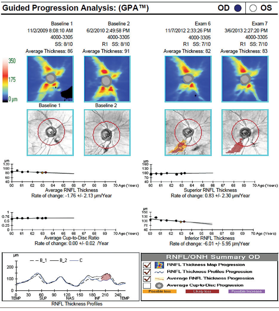 revoptom's tweet photo. Higher 24-Hour IOP Fluctuation Associated with Thinner RNFL

This measurement may serve as an independent risk factor for progressive structural loss in glaucoma, study finds. Read more: https://t.co/Lr7wZx7mXg

#retina #glaucoma #optometry #optometrist #eyecare https://t.co/GKg7Akjat5