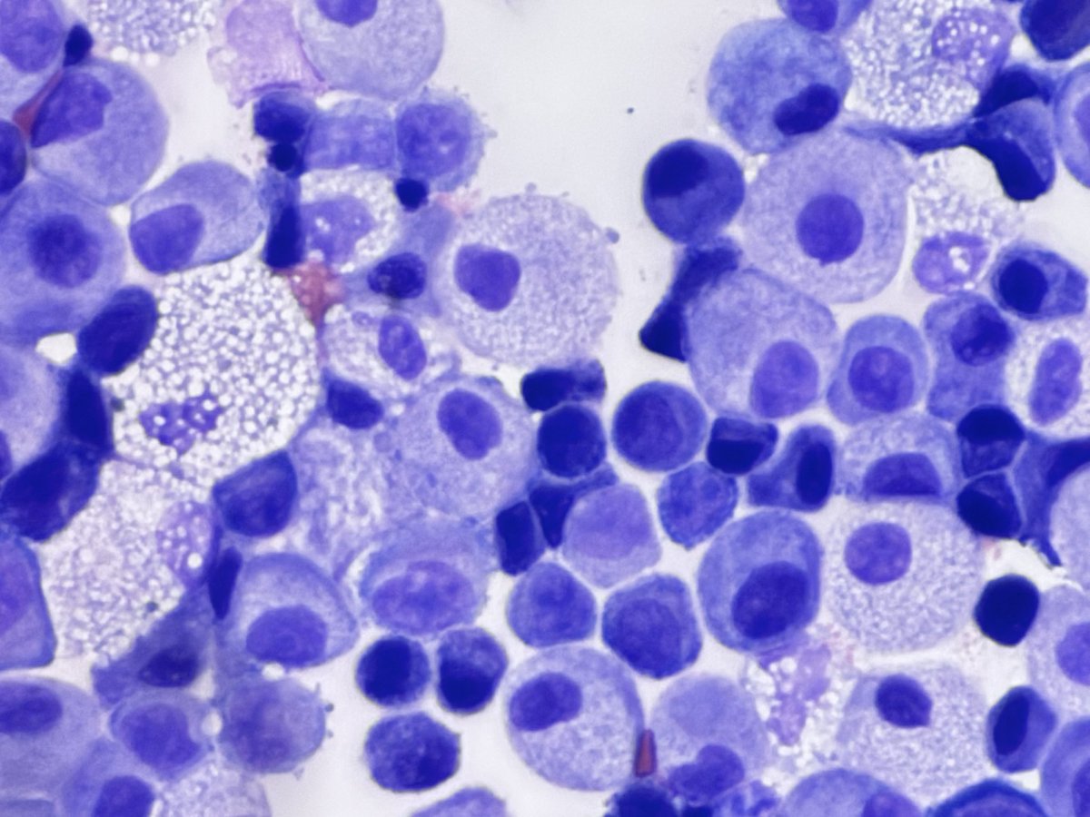 PathologyKate's tweet photo. This came to me as negative for malignant cells from the cytotech.  These deceptively bland cells are all basically all malignant and BER-EP4 positive.  Take a guess about their origin.  #boardfodder https://t.co/TzGedVTdER