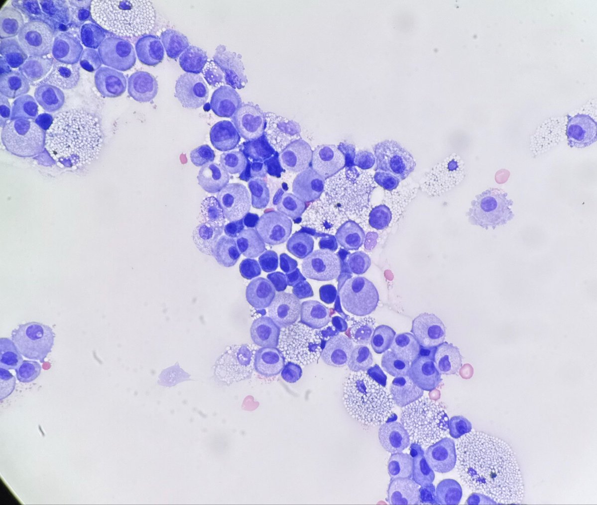 PathologyKate's tweet photo. This came to me as negative for malignant cells from the cytotech.  These deceptively bland cells are all basically all malignant and BER-EP4 positive.  Take a guess about their origin.  #boardfodder https://t.co/TzGedVTdER