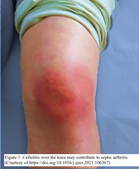 Path4People's tweet photo. 🛑  🆘  Septic arthritis is a ddx to NOT  miss

💧 Fluid appearance: Can be purulent, thick
🦠   WBC Count: Often > 100,000 uL with >75-90% neutrophils
🥼  Gram stain and fluid cultures can confirm
🗺️  Via hematogenous or direct inoculation
💊 Joint drainage, IV antibiotics https://t.co/mFcDQ9HU4I