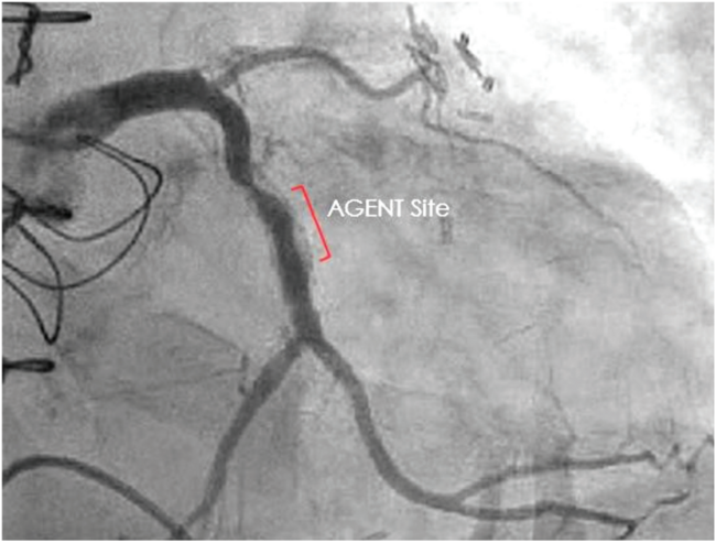 InvasiveCardiol's tweet photo. Brian K. Jefferson, MD, reviews complex recurrent ISR treated w/ the AGENT™ DCB. An AGENT-treated segment remained patent >3 yrs, while a separate adjacent segment treated w/ POBA 13 mos later restenosed within 6 mos.

https://t.co/a6elNbuGyc https://t.co/GsnAckB5tO