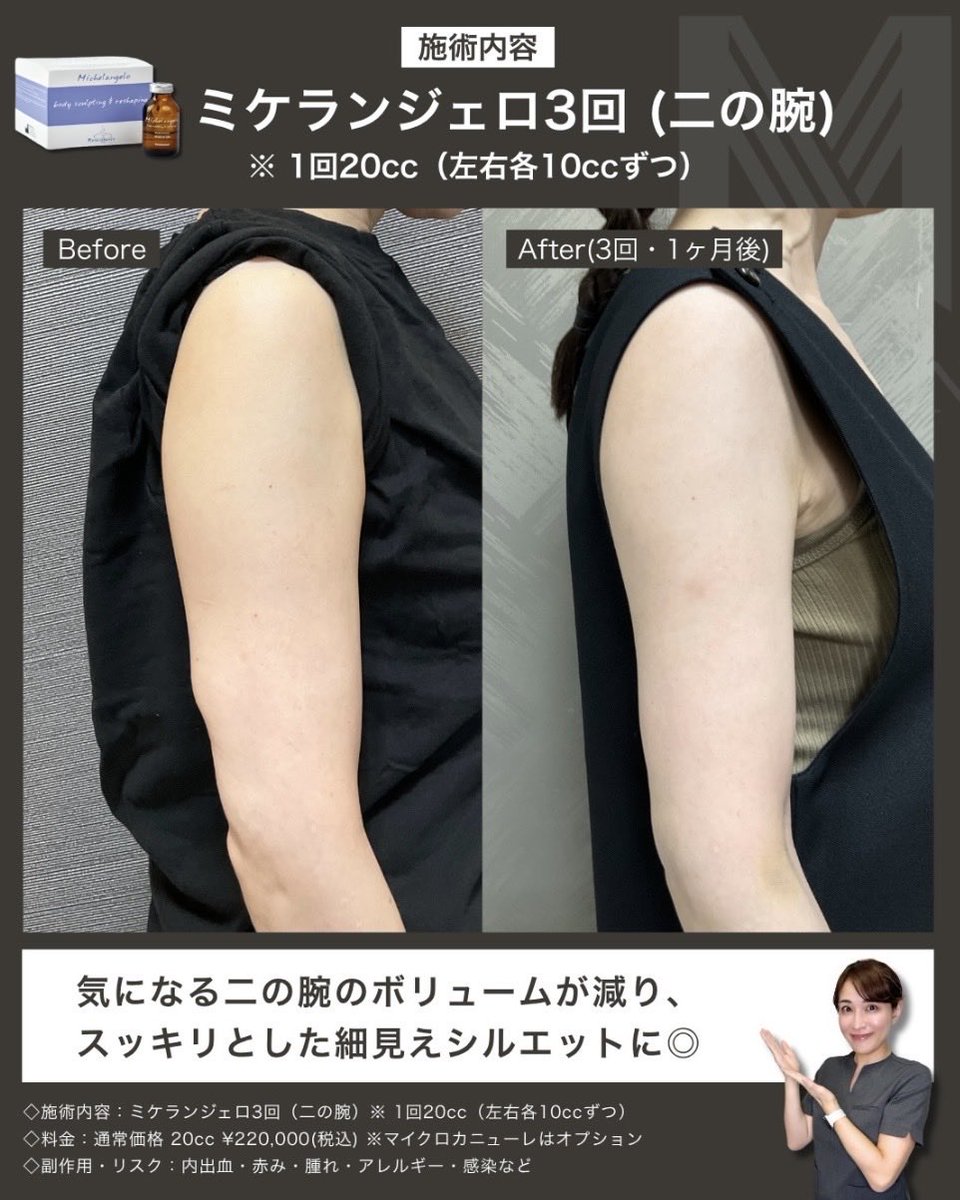 MiSA_Clinic's tweet photo. 脂肪溶解注射ミケランジェロの症例💉

高濃度の脂肪溶解成分を配合した次世代の脂肪溶解注射です❣️

✔︎ 脂肪細胞へのアプローチ力が高い
✔︎ 腫れや痛みが比較的少ない
✔︎ リバウンドしにくい
のが特徴

壊す → 分解する → 燃焼する → 排出するというロジックで、効率よく部分痩せをサポート✨ https://t.co/P5XJSVApQA