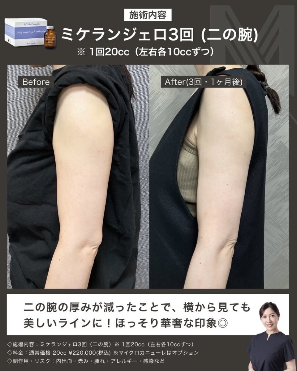 MiSA_Clinic's tweet photo. 脂肪溶解注射ミケランジェロの症例💉

高濃度の脂肪溶解成分を配合した次世代の脂肪溶解注射です❣️

✔︎ 脂肪細胞へのアプローチ力が高い
✔︎ 腫れや痛みが比較的少ない
✔︎ リバウンドしにくい
のが特徴

壊す → 分解する → 燃焼する → 排出するというロジックで、効率よく部分痩せをサポート✨ https://t.co/P5XJSVApQA