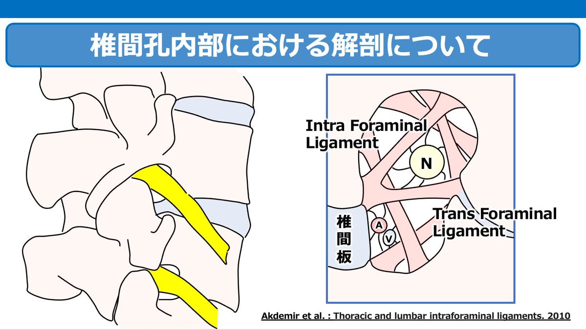 Spo_Lab's tweet photo. 「腰椎椎間孔狭窄症」を徹底解説！

▶️ 椎間孔内・外の組織に関する解剖学的知見 ▶️ 椎間孔狭窄症に特徴的な症状 ▶️ 画像所見とその評価のポイント

本セミナーでは、これらの内容を詳しく解説した上で、機能解剖学に基づき、椎間孔内・外における病態をどのように推定するのか？
ーー
脊椎の視点から”大腿部の痛み”を再考する 
〜機能解剖から紐解く評価と運動療法〜 
https://t.co/aJcyjbvfqk
