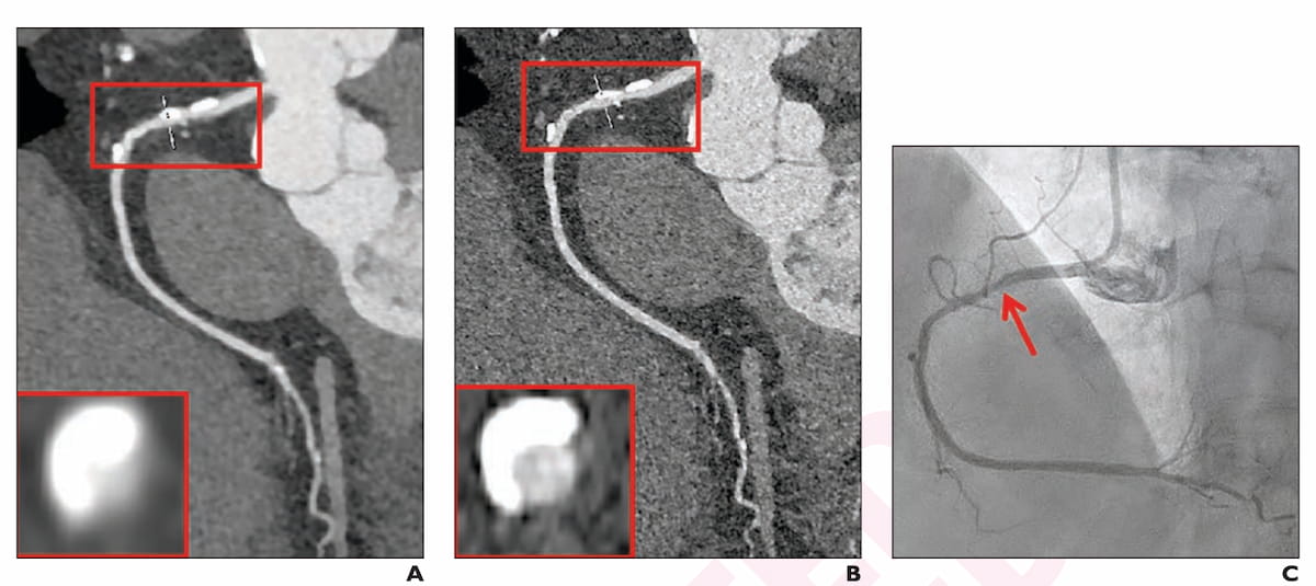 Applied_Rad's tweet photo. Study Shows Enhanced Diagnosis of Coronary Artery Stenosis with Photon-Counting CTA
 
📰🔗 Read more: https://t.co/LP8djGpcOa 

A recent study published by @RadiologyACR  examined the diagnostic performance of standard-resolution and ultra-high-resolution modes in coronary computed tomography angiography (CCTA) using photon-counting detector CT (PCD CT). 

#Radiology #Imaging #RadNews #RadiologyNews