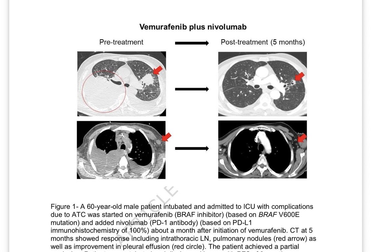 Dr_R_Kurzrock's tweet photo. Slaying anaplastic  thyroid cancer.  Review of new therapies.  Patient was intubated.  Treated with vemurafenib for Brafv600e) and nivolumab for very high pdl1 with dramatic response.  —extubated, drove himself home to another city https://t.co/GnoNFmsDCi