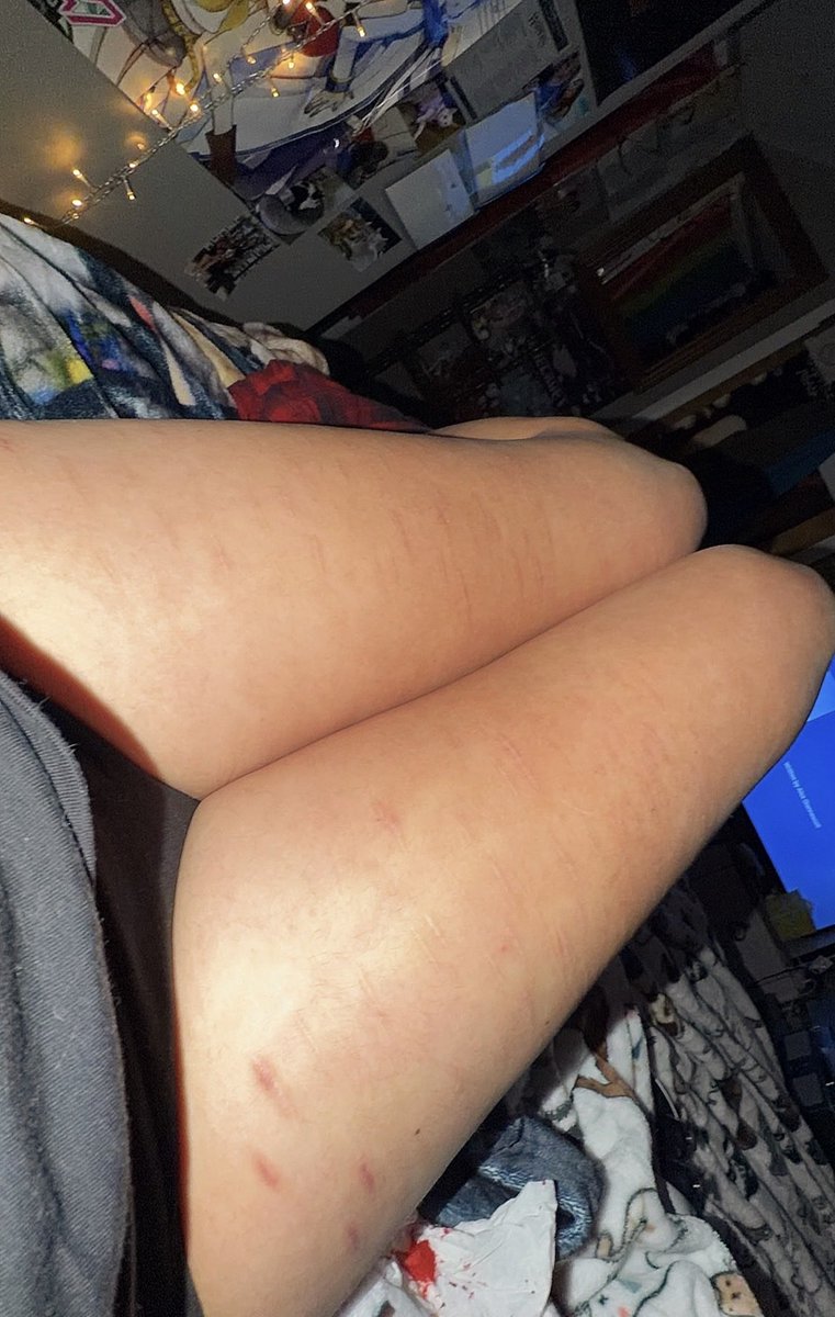 phuxphill's tweet photo. I hate how my scars from my car crash are healing #sfxmakeup #shedrtwt #scarspo https://t.co/qO5tbq41iT