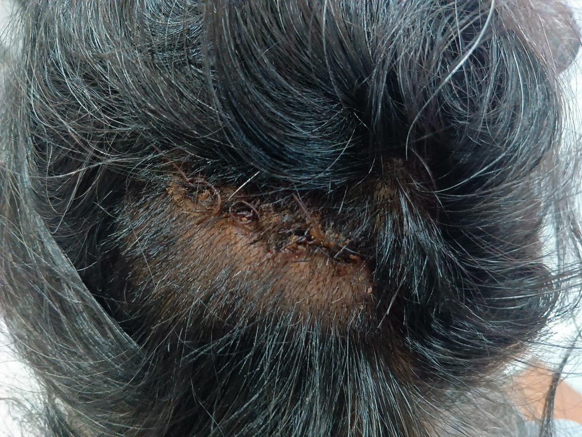 ColAmitkumar's tweet photo. CONTINUING ATTACKS ON VETERANS AND FAMILY : SERIOUS ISSUE AND WE MUST STAND TOGETHER FOR JUSTICE !! FORWARDING THE REQUEST: MUST SHARE! 
From a Sikh Light Infantry Veteran – Sapinder Singh
I am Sapinder Singh, a proud veteran of the Sikh Light Infantry.
I served my country with honour. Today I stand with a bleeding heart, not for myself, but for the dignity of every veteran and every family that looks to the uniform for protection.
On the night of 3rd October 2026, my family and I were brutally attacked outside our home in Village Berpur (Kherpur), Block Majri, SAS Nagar.
While I was on duty as a security guard, a group led by Gurmukh Singh, his son Lovpreet Singh, Sulakhan Singh, Gurnoor Singh, Prabhjot Singh and 5-6 others came to my house, hurled abuses, threw bricks and stones, and then launched a violent assault.
I was pushed to the ground and struck on the head with an iron rod.
My daughter Simranpreet Kaur was slapped, thrown to the ground, and then molested / outraged in modesty by Lovpreet Singh.
My elderly father Kashmira Singh and my brother Satnam Singh were also beaten.
A sharp-edged weapon (kirpan-like) was used on me.
We were left injured and bleeding. We had to be admitted to Civil Hospital, Kurali.
FIR No. 0096 dated 04.10.2026 has already been registered at Police Station Block Majri under Sections 74, 126(2), 115(2), 118(1), 351(2), 191(3) & 190 of the Bharatiya Nyaya Sanhita.
Yet the accused are still roaming free.
I demand immediate and fair action:
Arrest of all named accused without further delay.
Protection for me and my family.
Speedy investigation and charge-sheet.
This is not just an attack on one family. This is an attack on a Sikh Light Infantry veteran who served the nation. If a soldier’s family can be assaulted like this in Punjab, what message does it send to every serving and retired jawan?
I appeal to all fellow veterans, especially those from Sikh Light Infantry and nearby units – please stand with me. Your voice and presence matter.
I request the following authorities for urgent intervention:
@BhagwantMann (CM Punjab)
@DGPPunjabPolice @PunjabPoliceInd 
@SSP_SASNagar @dcmohali
@adgpi (Indian Army) – for the protection and dignity of veterans
A veteran does not beg for justice.
He only asks that the system he served does not abandon him when he needs it most.
Jai Hind.
Sapinder Singh
Sikh Light Infantry Veteran
Village Berpur, SAS Nagar
FIR Details
Date & Time of FIR: 04/10/2026 at 20:20 hrs
Date & Time of Occurrence: 03/10/2026, between approx. 01:05 hrs and 01:40 hrs
Place of Occurrence: Village Berpur / Kherpur (South, about 5 km from PS), Block Majari, SAS Nagar, Punjab
