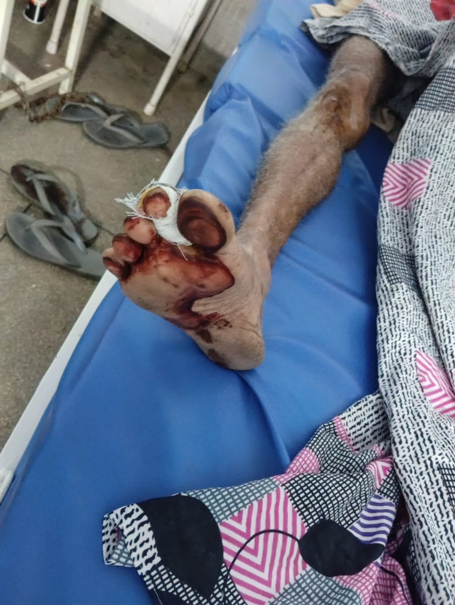 ColAmitkumar's tweet photo. CONTINUING ATTACKS ON VETERANS AND FAMILY : SERIOUS ISSUE AND WE MUST STAND TOGETHER FOR JUSTICE !! FORWARDING THE REQUEST: MUST SHARE! 
From a Sikh Light Infantry Veteran – Sapinder Singh
I am Sapinder Singh, a proud veteran of the Sikh Light Infantry.
I served my country with honour. Today I stand with a bleeding heart, not for myself, but for the dignity of every veteran and every family that looks to the uniform for protection.
On the night of 3rd October 2026, my family and I were brutally attacked outside our home in Village Berpur (Kherpur), Block Majri, SAS Nagar.
While I was on duty as a security guard, a group led by Gurmukh Singh, his son Lovpreet Singh, Sulakhan Singh, Gurnoor Singh, Prabhjot Singh and 5-6 others came to my house, hurled abuses, threw bricks and stones, and then launched a violent assault.
I was pushed to the ground and struck on the head with an iron rod.
My daughter Simranpreet Kaur was slapped, thrown to the ground, and then molested / outraged in modesty by Lovpreet Singh.
My elderly father Kashmira Singh and my brother Satnam Singh were also beaten.
A sharp-edged weapon (kirpan-like) was used on me.
We were left injured and bleeding. We had to be admitted to Civil Hospital, Kurali.
FIR No. 0096 dated 04.10.2026 has already been registered at Police Station Block Majri under Sections 74, 126(2), 115(2), 118(1), 351(2), 191(3) & 190 of the Bharatiya Nyaya Sanhita.
Yet the accused are still roaming free.
I demand immediate and fair action:
Arrest of all named accused without further delay.
Protection for me and my family.
Speedy investigation and charge-sheet.
This is not just an attack on one family. This is an attack on a Sikh Light Infantry veteran who served the nation. If a soldier’s family can be assaulted like this in Punjab, what message does it send to every serving and retired jawan?
I appeal to all fellow veterans, especially those from Sikh Light Infantry and nearby units – please stand with me. Your voice and presence matter.
I request the following authorities for urgent intervention:
@BhagwantMann (CM Punjab)
@DGPPunjabPolice @PunjabPoliceInd 
@SSP_SASNagar @dcmohali
@adgpi (Indian Army) – for the protection and dignity of veterans
A veteran does not beg for justice.
He only asks that the system he served does not abandon him when he needs it most.
Jai Hind.
Sapinder Singh
Sikh Light Infantry Veteran
Village Berpur, SAS Nagar
FIR Details
Date & Time of FIR: 04/10/2026 at 20:20 hrs
Date & Time of Occurrence: 03/10/2026, between approx. 01:05 hrs and 01:40 hrs
Place of Occurrence: Village Berpur / Kherpur (South, about 5 km from PS), Block Majari, SAS Nagar, Punjab