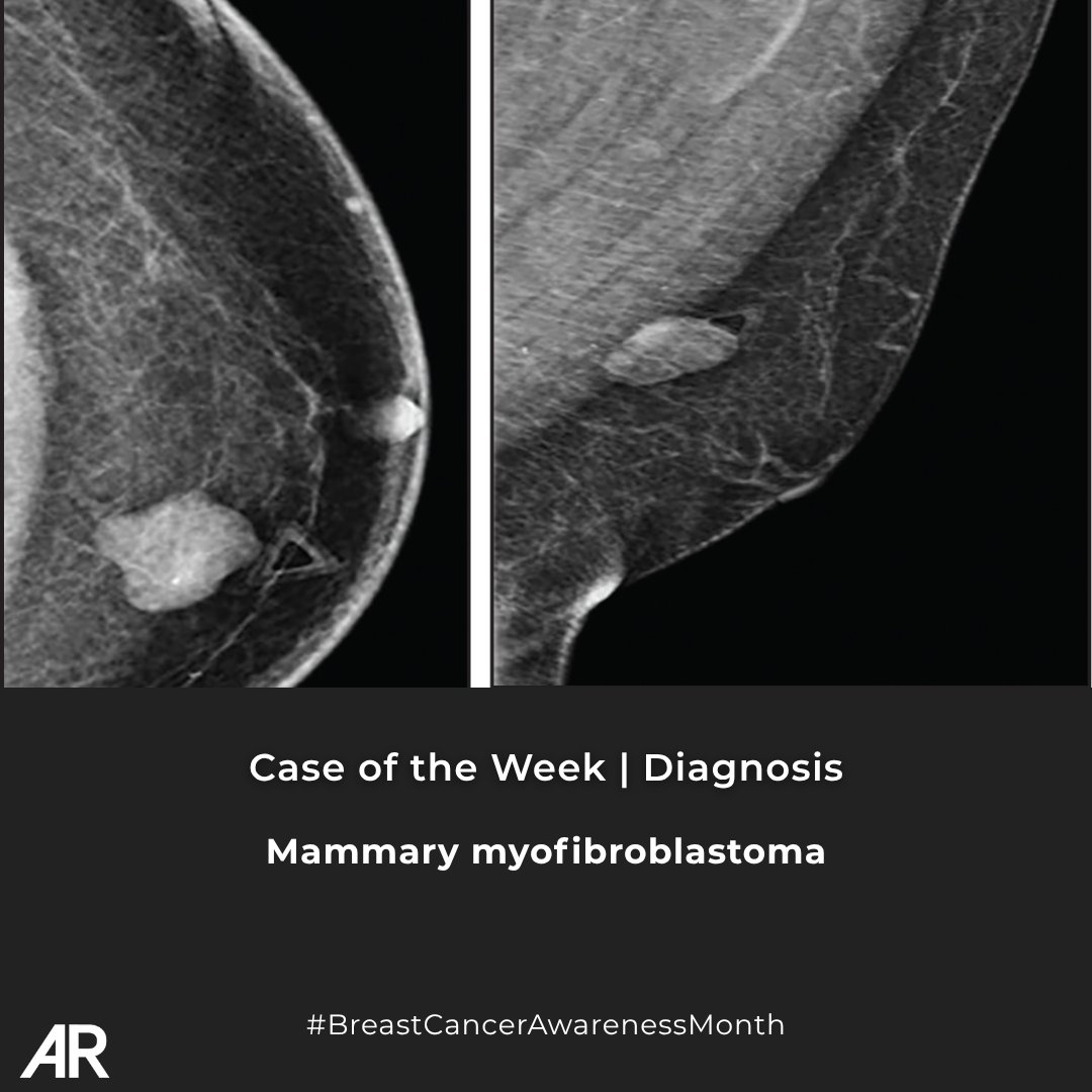 Applied_Rad's tweet photo. 🩻 Case Study of the Week - Diagnosis Time!

Mammary myofibroblastoma

🔗 See all the case details, more images, and the diagnosis: https://t.co/Ul0KwueG6K 

#Radiology #Imaging #Radiologist #MedicalImaging #BreastCancerAwarenessMonth #BreastCancerAwareness #BreastCancer #COW #CaseOfTheWeek