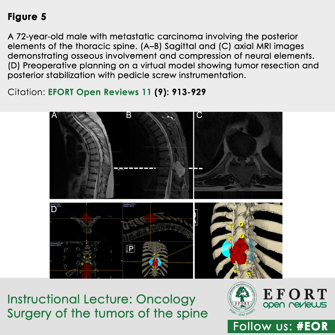 EFORTnet's tweet photo. Managing #SpinalTumours requires balancing oncological contro, #NeurologicalPreservation & #SpinalStability
#EFORT #EOR #InstructionalLecture outlines modern #SurgicalStrategies & #SeparationSurgery frameworks for primary & #MetastaticSpineLesions
π https://t.co/tq6eJmw5Sg https://t.co/kGFSdsIe3d