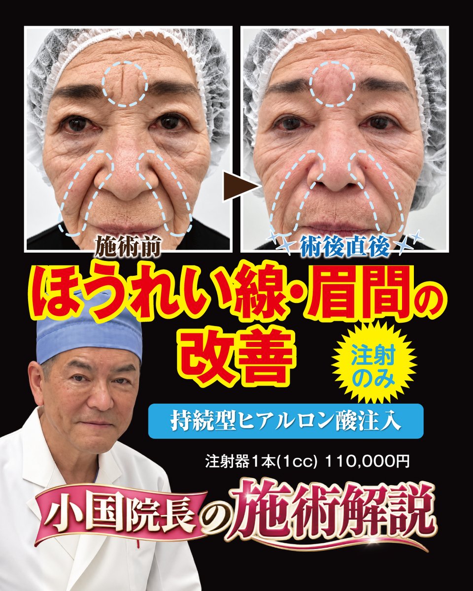 STAFF05186861's tweet photo. ほうれい線・眉間など
深いシワ・たるみの治療にも有効
長期持続型ヒアルロン酸

シワ・たるみには、部位や症状の範囲・深さによって様々なパターンがありますが、

#ヒアルロン酸注入  #ボリューマXC #ジュビダーム  #ほうれい線 #眉間のシワ #シワ取り #たるみ取り https://t.co/kdAAuzAJC8