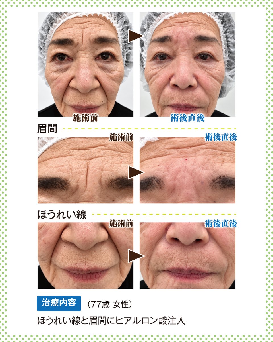 STAFF05186861's tweet photo. 長期持続型ヒアルロン酸「ボリューマXC」はボリュームアップに適した弾性と凝集性をバランスよく併せもっているため、高齢の方の深いシワや重度のたるみの治療にも有効です。

#ヒアルロン酸注入 #ボリューマXC https://t.co/mPZnK5JFR7