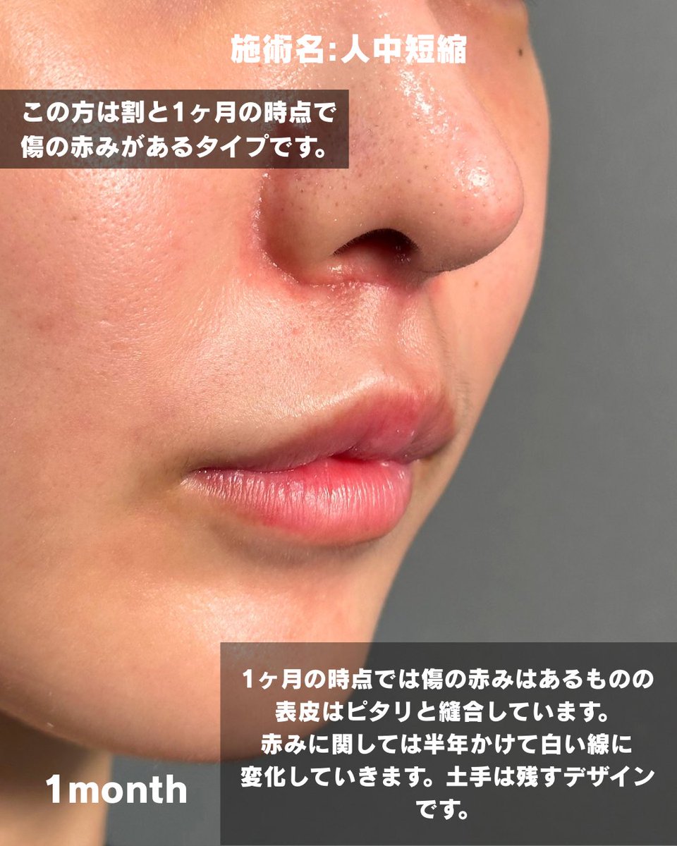 prism_morimoto's tweet photo. 内側人中短縮の術前・術後経過。

デザインは、鼻柱から滑らかなカーブを描くように。

術後1ヶ月ではまだ傷の赤みが残っていますが、創縁はピタリと合っています。

傷跡は1ヶ月で完成するものではありません。
ここから時間の経過とともに、赤みが徐々に改善していくことが期待されます。
↓ https://t.co/ktuaZsexFE