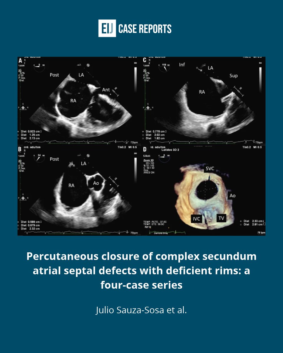 EIJCaseReports's tweet photo. Deficient rims (<5mm) in adult ASDs?❌ Surgery isn't the only option.
Julio Sauza-Sosa et al. share advanced transcatheter maneuvers (aortic straddling, PV-support &amp; LA roof deployment) to safely achieve 100% percutaneous success 👇
https://t.co/V5SZsp35Ln
#FOAMed #CardioEd https://t.co/C5XcBxCI7m