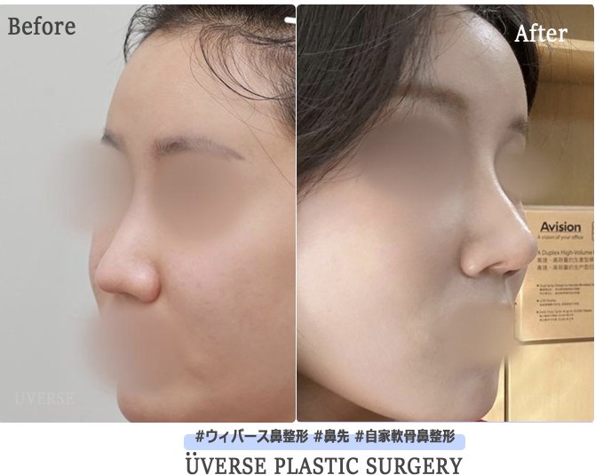 uverse_jp's tweet photo. 🧑‍⚕️鼻先の高さも、横顔の美しさも。 
大切なのは、お顔全体との調和✨

自家組織を用いて、自然な立体感と すっきりとした鼻先を目指します🦋

鼻整形なら、ウィバース😉
#ウィバース症例 #鼻整形 #韓国美容

お問い合わせ&amp;ご相談はウィバース公式LINEへ
 ⇒ 💌https://t.co/6jGa8NJoXl https://t.co/p6DdcSS1jH