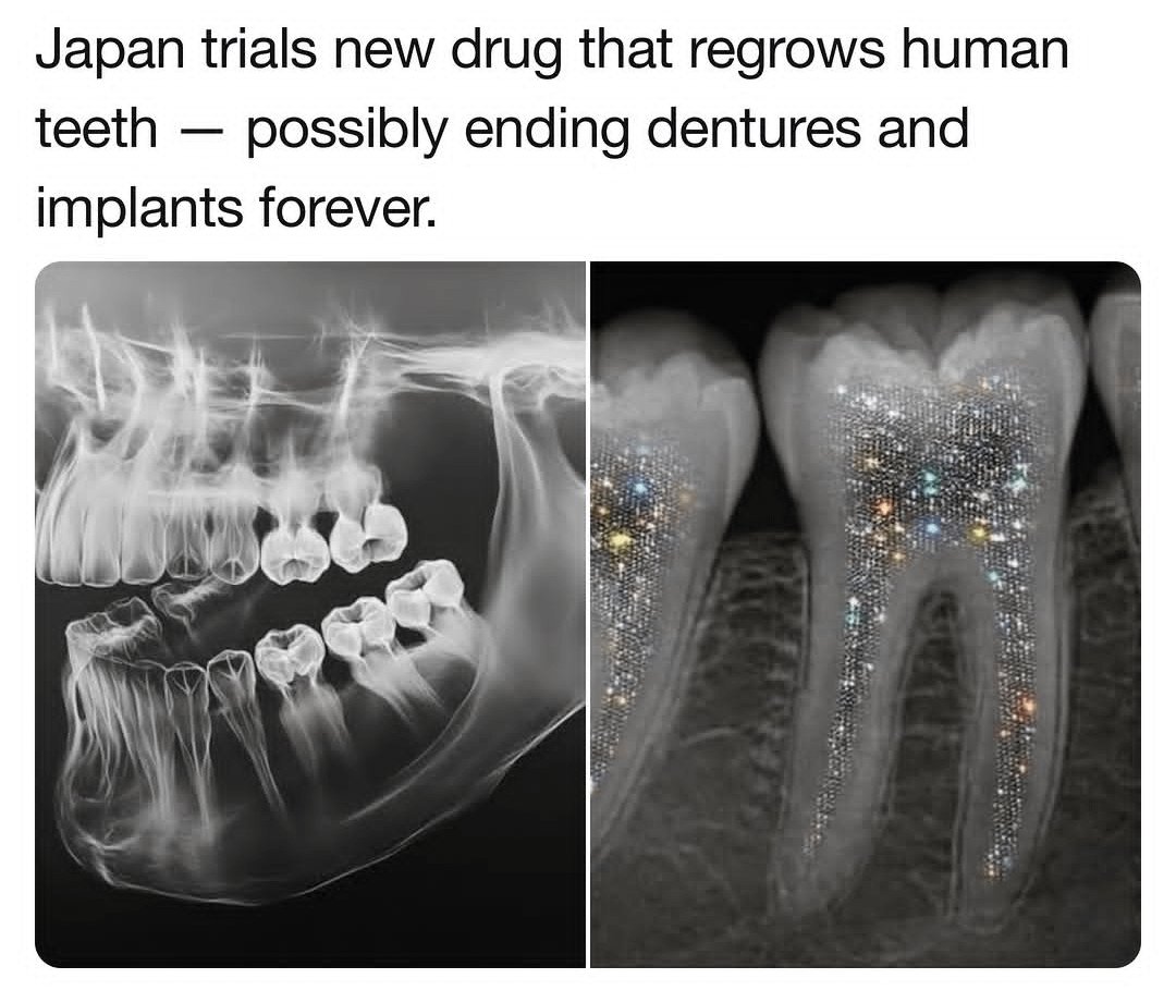 DailyChoasX's tweet photo. Dentures and implants could soon be history. 🦷 Scientists completed Phase I trials on a drug (TRG-035) that blocks USAG-1 to wake up dormant tooth buds and regrow natural teeth. Phase II in children with congenital tooth loss is next, targeting a 2030 launch! https://t.co/tnPC4NXGRZ