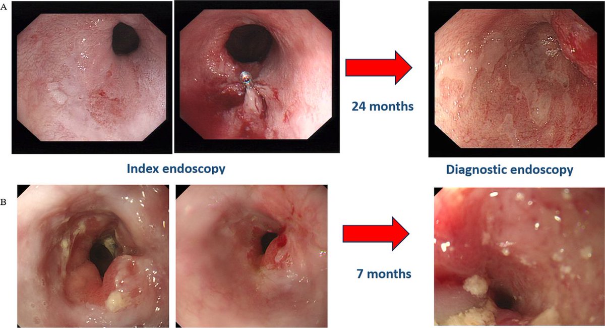 FrontGastro_BMJ's tweet photo. 🚨 🚨 New article in Frontline Gastroenterology

Srinivasa et al linked national cancer registry and HES data for 56,827 people diagnosed with oesophageal cancer in England between 2018 and 2024. They asked how many had their oesophagus dilated for a stricture in the 2 years before the cancer was diagnosed.

🔑 Key findings:
1️⃣ About 1 in 80 (1.2%) had dilatation before diagnosis, and in 36.4% this was more than 3 months before
⚠️ Dilatation was more likely in women, in squamous cell carcinoma and with more comorbidity
💥 3.9% had a perforation, with higher risk in women and after 4 or more dilatations
🔁 51.7% had no endoscopic follow-up after dilatation, and follow-up was linked to less advanced cancer at diagnosis

�� Characterise strictures with image-enhanced endoscopy and adequate biopsies before dilating. Re-biopsy strictures that respond poorly, and build follow-up into stricture pathways.

Read the full paper 🔗
https://t.co/4yh1Yw72Sl

@BritSocGastro @dr_aditi_kumar @OTavabie @DrJMKennedy @DunnePdj @TrevorTabone @eathar_s @IrenePerezMD @KGananandan @zare_benjamin @dtleiberman