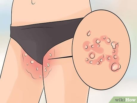 Xbiohack's tweet photo. 8 HOME REMEDIES FOR SEVERELY DRY SKIN

Cracked, tight, itchy skin doesn't need an expensive cream. The fix is probably already in your kitchen.

1. Honey https://t.co/IuIkLNYPQl