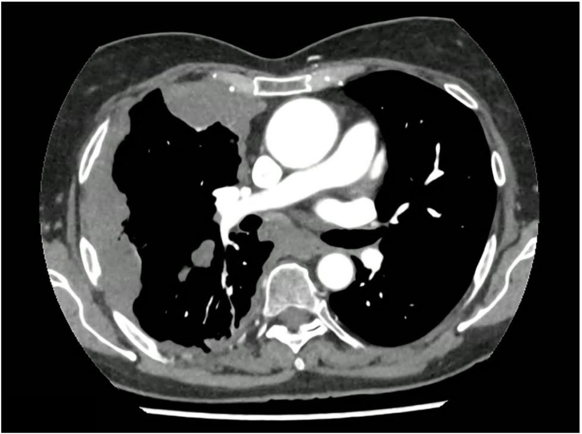 ArchBronconeumo's tweet photo. 🩺 Pleural involvement in peritoneal pseudomyxoma poses significant therapeutic challenges.

🔬 This case report describes the use of hyperthermic intrathoracic chemotherapy (HITHOC) in conjunction with surgery 👇

🔗 https://t.co/OtpkQW409F

#ArchivosDeBronconeumología #SEPAR https://t.co/1v2OZDutJX