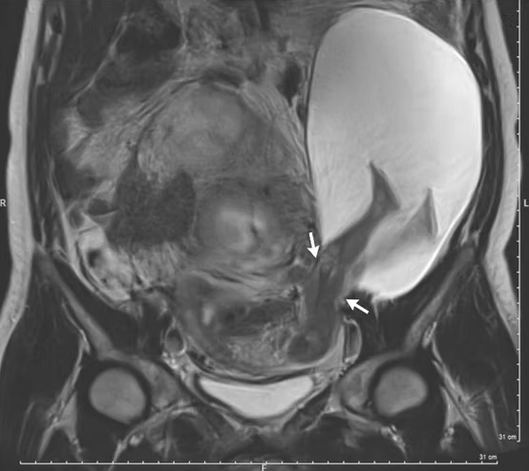 MarcGozlan's tweet photo. Un fœtus avec les jambes à l’extérieur de l’utérus
Une incroyable anomalie obstétricale ! https://t.co/w2Y3mgI7Xw [Rediff] https://t.co/ZfELJpWUji