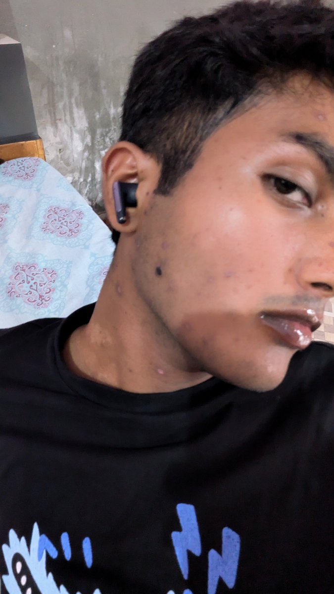 twinkffs's tweet photo. My sugar daddy broke up w me after I got chicken pox earlier this summer and i kinda don't blame him 😭 https://t.co/zYgq7Naq9I