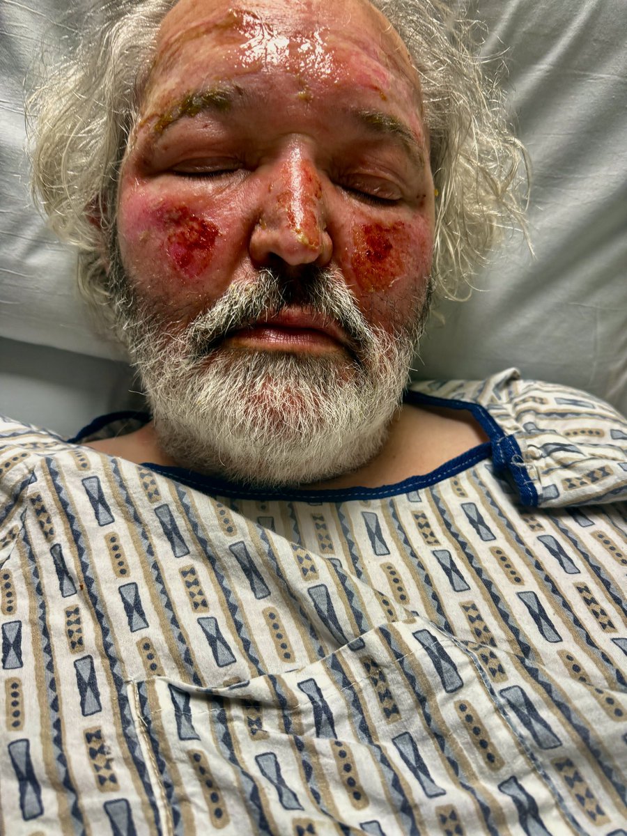 LISAT2408's tweet photo. My husband had an accident on Sep. 28th and had 3rd degree burns to his face. He is healing but it is a slow process. Our only car is now not fixable. I am looking for a remote job asap, bills are piling up and rent was due. If you can help, link below. RT/Share 🙏  https://t.co/3OXyFDXwNH
#MutualAidRequest #GoFundMe #family #RentRelief #EmergencyFund