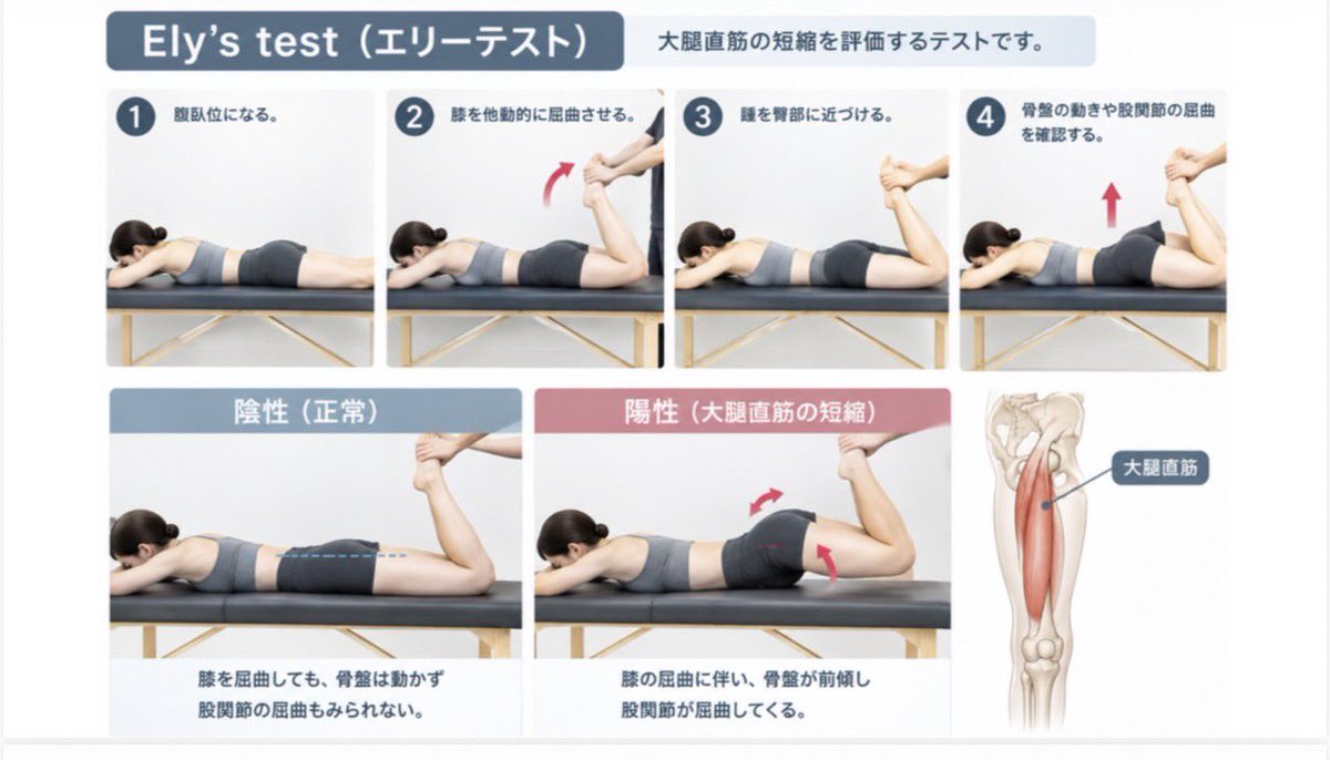 Spo_Lab's tweet photo. 効率よく歩くために、大腿直筋に注目したことはありますか？
その評価が、歩行を変えるヒントになる。
Ely’s testから紐解く、歩行分析とエクササイズ選択。 https://t.co/SY6JfYSlXl