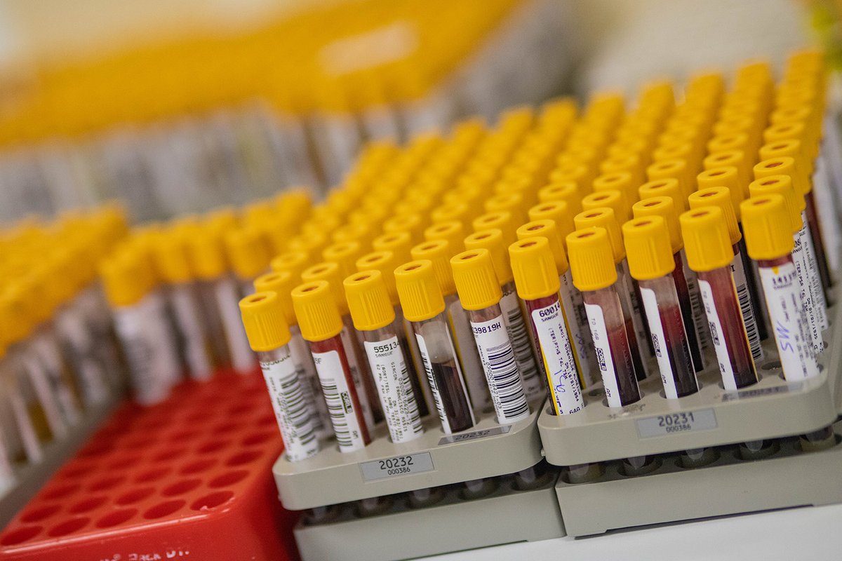 Lab_Network's tweet photo. Exame de sangue poderá antecipar o risco de hipertensão pulmonar

Estudo analisou cerca de 5 mil proteínas e identificou dez associadas ao desenvolvimento da doença. Resultados apontam a NOTCH3 como possível alvo para novos tratamentos. Conheça a pesquisa: https://t.co/cwCPrMmphZ https://t.co/RLNWMWTLpy