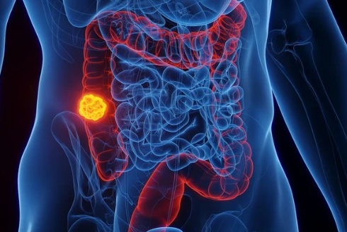 USFResearch's tweet photo. Researchers from USF Health and Tampa General Hospital have identified a key mechanism that helps metastatic colorectal cancer evade immune defenses, a discovery that could improve future cancer treatments. 🔬https://t.co/LSo3KqOdml @USFHealth @TGHCares https://t.co/2fWtKcxdZ2