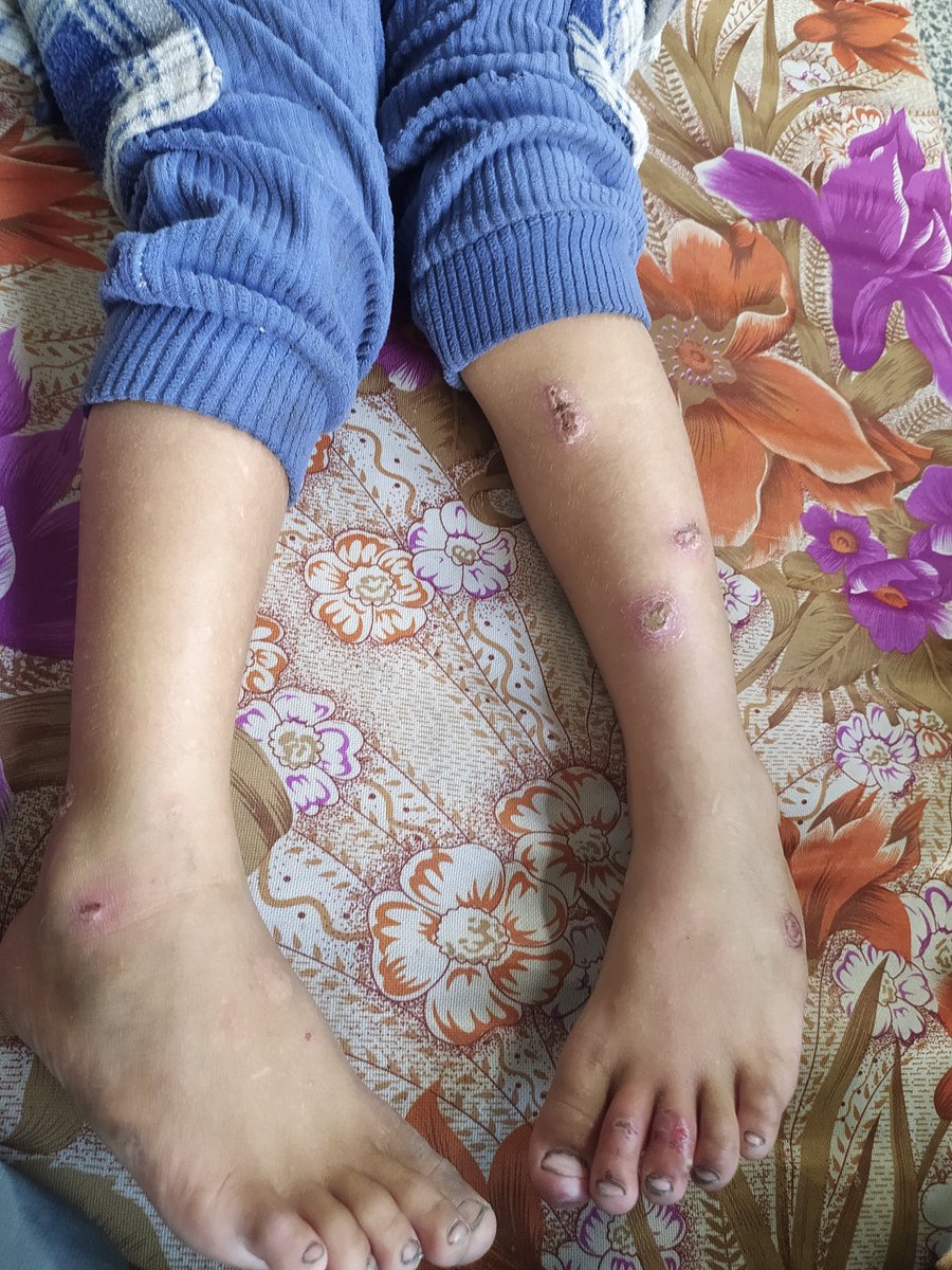 AbrahymA283's tweet photo. 💔 This is my son Nahid. He is suffering from a severe infection and desperately needs medical treatment. I need $150 to cover his treatment and medicine, but I cannot afford it. Please help my little boy, even with a small donation, or share https://t.co/9SdHhjsRhF https://t.co/KrirjudBEC