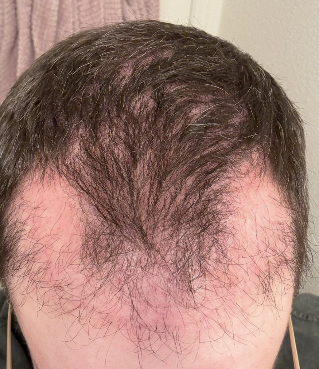 anagenxyz's tweet photo. This week in MINX.

The hair growth reports may shock you. (1/7) https://t.co/IqPqTM2le9
